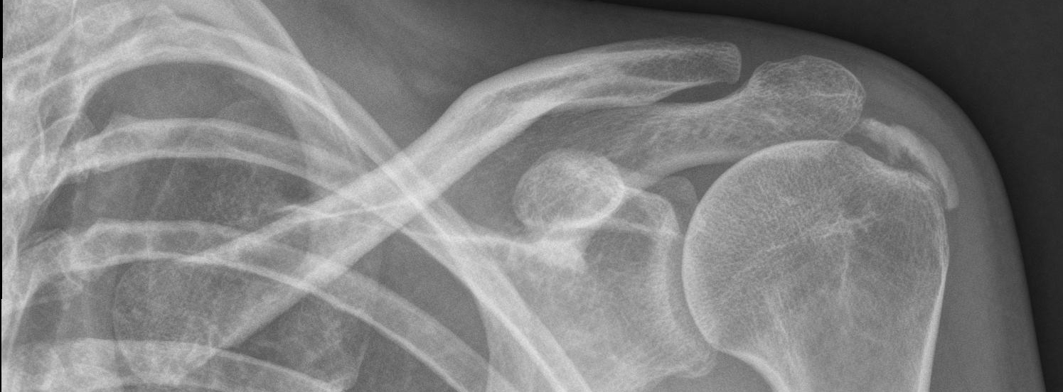 Shoulder Calcific Tendonitis